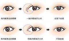 开眼角前要注意什么?一定记住这几点! width=