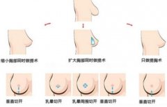 女性乳房不对称如何矫正整形？于下颌角？！ width=