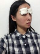 山东省立医院整形美容科崭新2019价目表【全切双眼皮案例前后对比】 width=