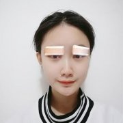 薛旦整形双眼皮三个月对比图 width=
