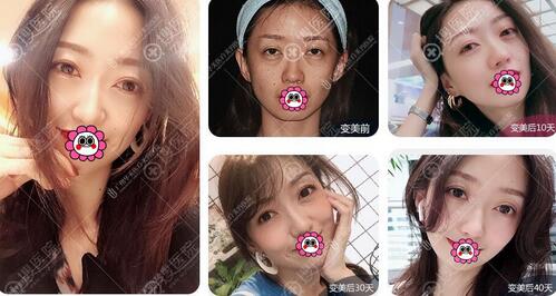 【广州华美整形怎么样？三月特惠活动来袭！】