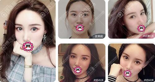 【广州华美整形怎么样？三月特惠活动来袭！】