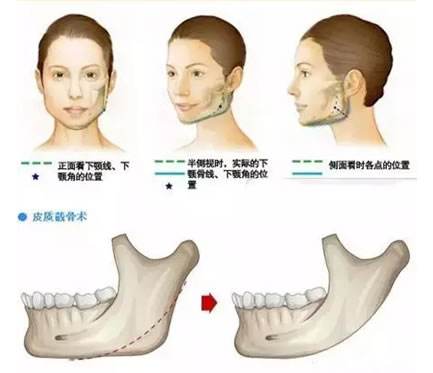 下颌角磨削多少钱?果好吗?