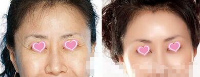 丁文婷医生面部微雕技术怎么样？