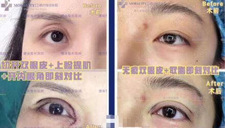 【高培培医生鼻修复怎么样？高培培医生鼻修复果图分享！】