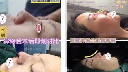 【高培培医生鼻修复怎么样？高培培医生鼻修复果图分享！】