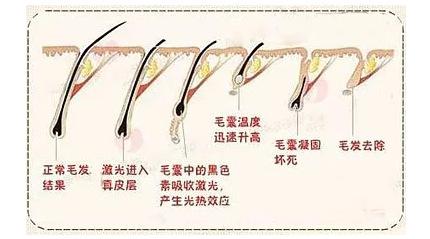 莱西尔脱毛需要多少钱?