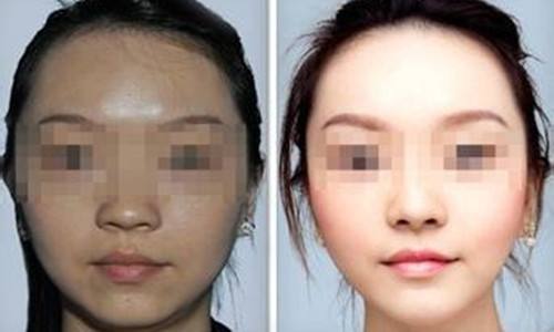 北京打美白多少钱?变白愿望~