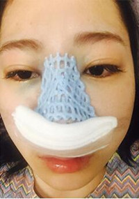黄大勇医生怎么样?北京圣嘉荣隆鼻真实案例