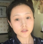 巫文云怎么样靠谱不?巫文云隆鼻案例对比分析! width=
