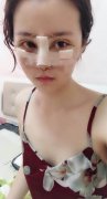 杜太超做鼻子好看吗?达拉斯隆鼻手术恢复过程分享! width=
