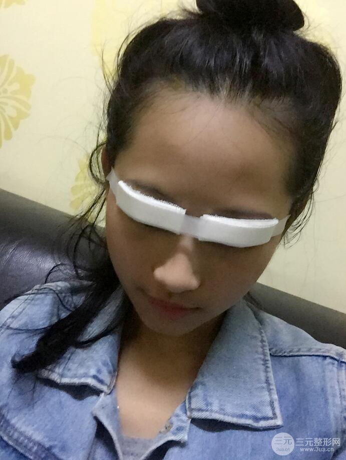广州紫馨曹仁昌双眼皮案例，见证曹仁昌医生的厉害之处！