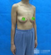 妙桃琴面丰胸真实术前术后对比图，恢复过程多方面直播 width=