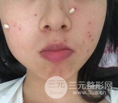 Q755激光祛伊藤痣后反黑怎么办?看我如何处理的!
