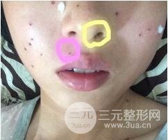 Q755激光祛伊藤痣后反黑怎么办?看我如何处理的!