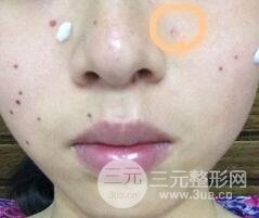 Q755激光祛伊藤痣后反黑怎么办?看我如何处理的!