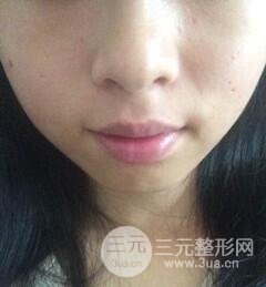 Q755激光祛伊藤痣后反黑怎么办?看我如何处理的!