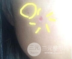 Q755激光祛伊藤痣后反黑怎么办?看我如何处理的!