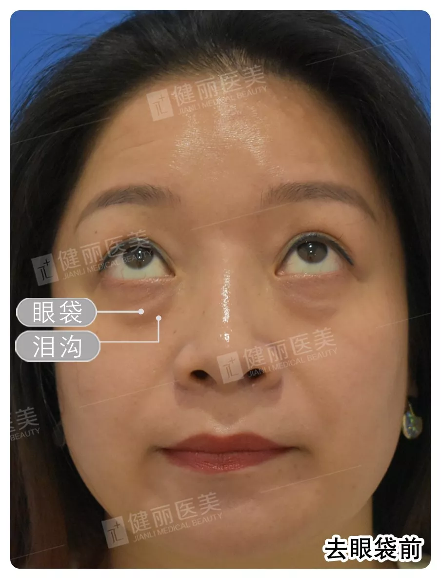 电波拉皮去眼袋