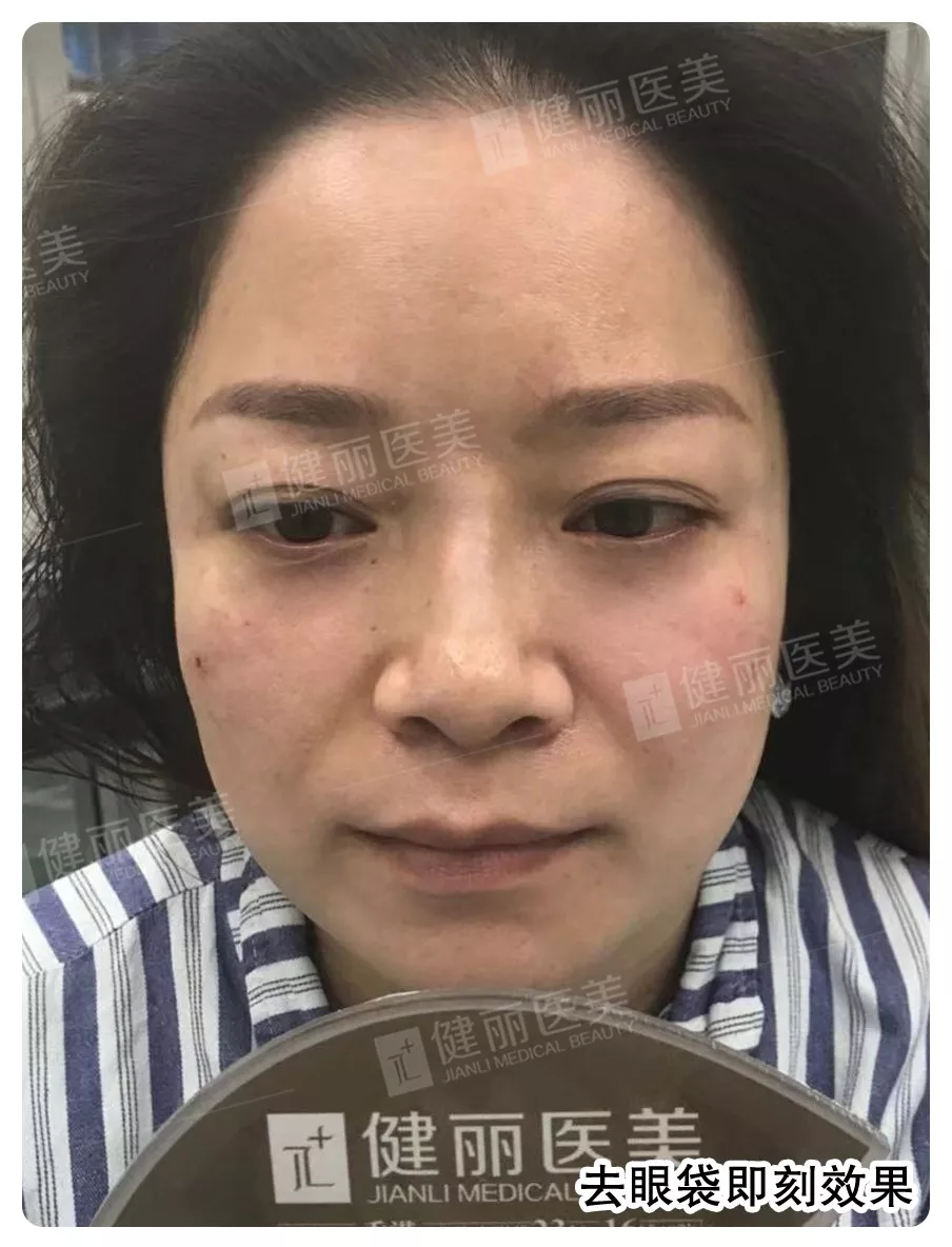 电波拉皮去眼袋