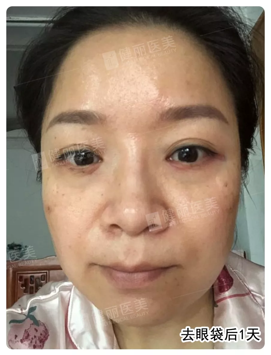 电波拉皮去眼袋