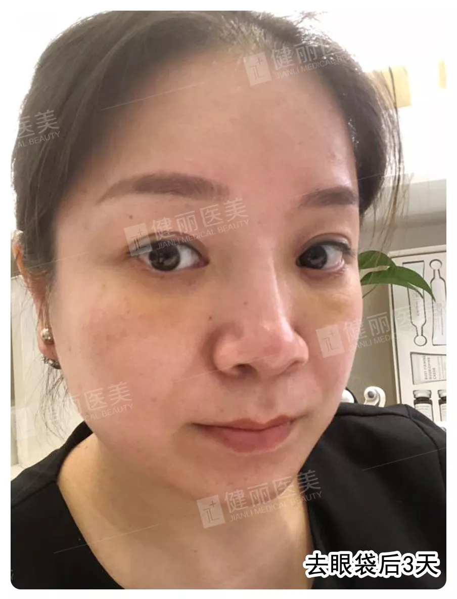 电波拉皮去眼袋