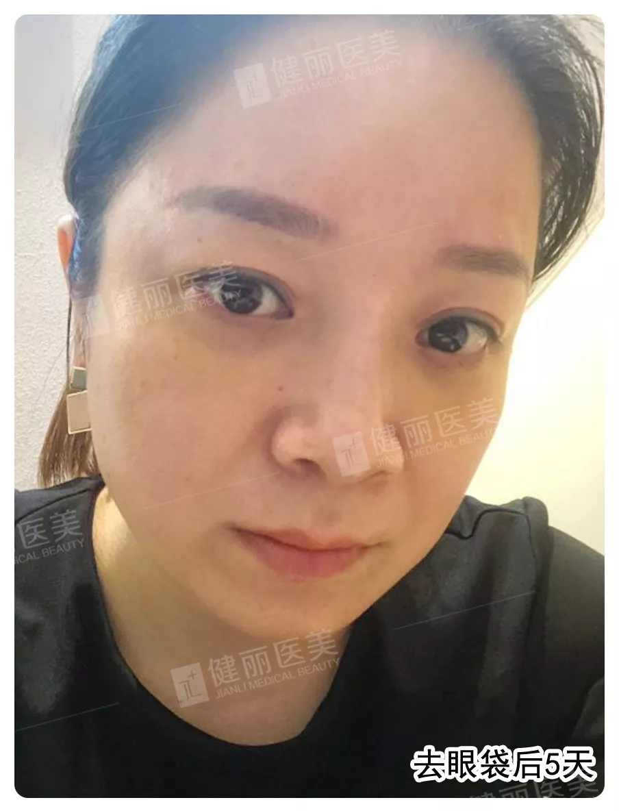 电波拉皮去眼袋