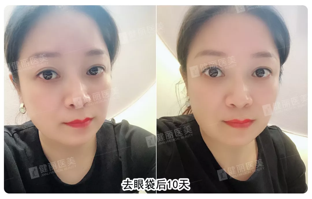 电波拉皮去眼袋