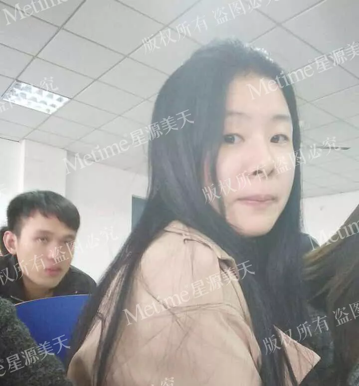 开眼角前后对比图片