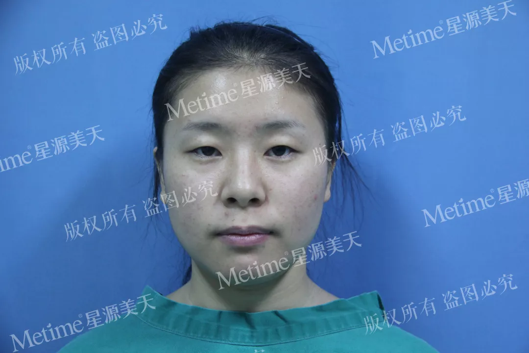 开眼角前后对比图片