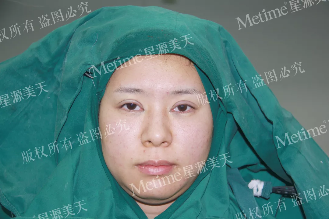 开眼角前后对比图片