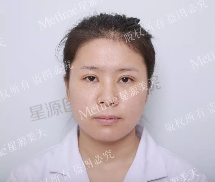 开眼角前后对比图片