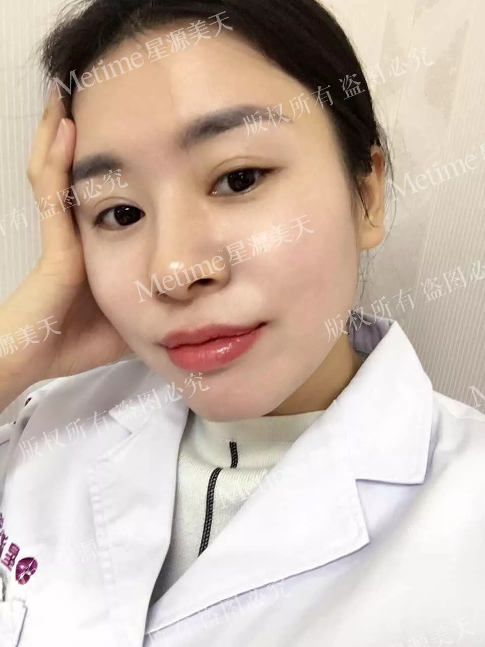 开眼角前后对比图片