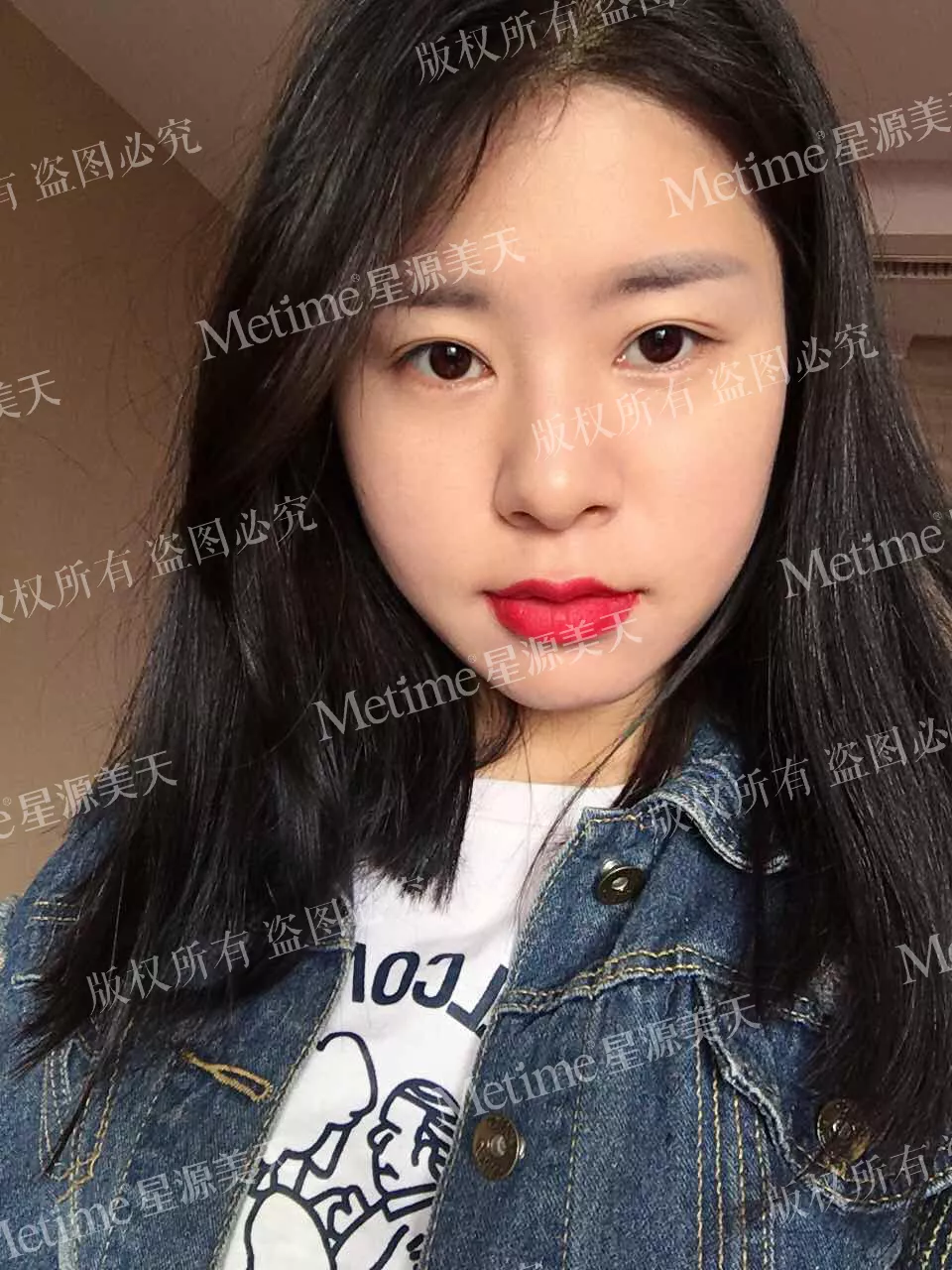 开眼角前后对比图片