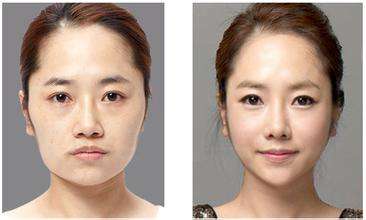 磨腮削骨多少钱?不用再羡慕V字脸的女人