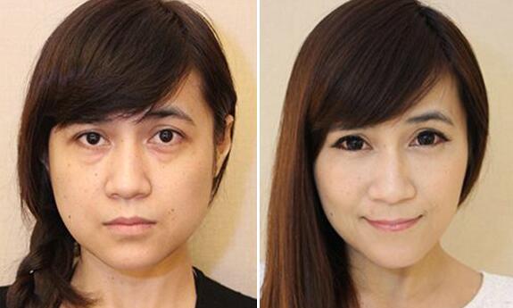 哈尔滨的陈晓君医生做去眼袋预约排队吗?哈尔滨******医院整形美容科为你解答