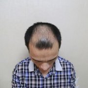 mmy植发案例恢复对比图：mmy植发果真的辣么好??? width=