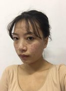 光子嫩肤案例介绍：光子嫩肤后的注意事项 width=