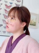 隆鼻梁真实案例分享：隆鼻梁后逆袭为精致的居居女孩! width=
