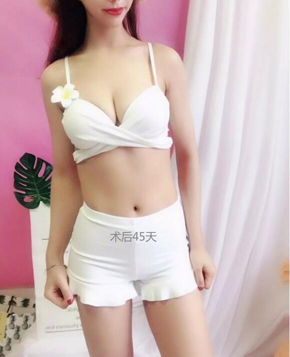水滴型假体隆胸