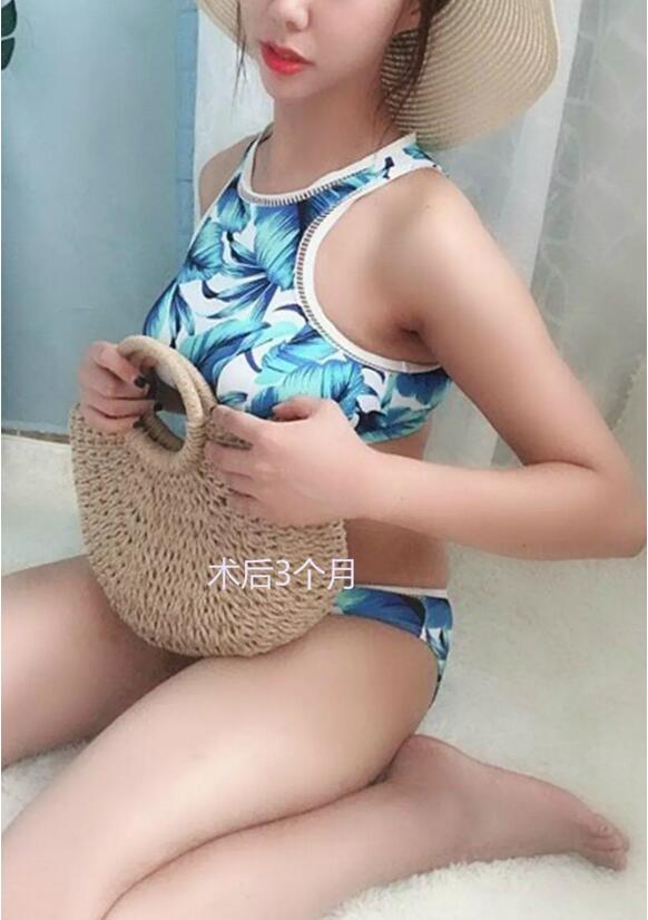 水滴型假体隆胸