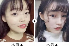 注射隆鼻前后对比图——鼻子漂亮鼻头也要！ width=