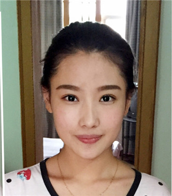打注射瘦脸前后果图