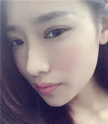打注射瘦脸前后果图