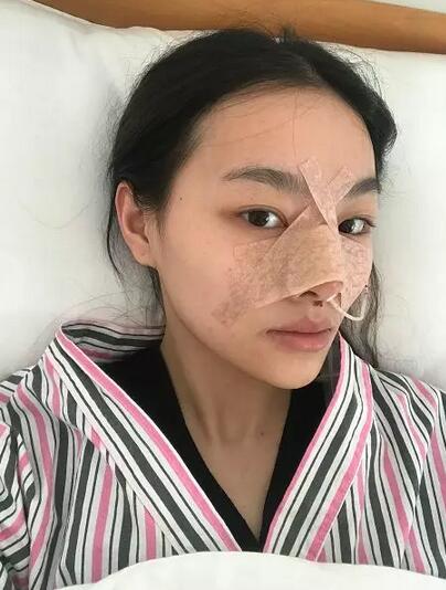 【玻尿酸隆鼻对比照片分享，术后一个月真实案例~】