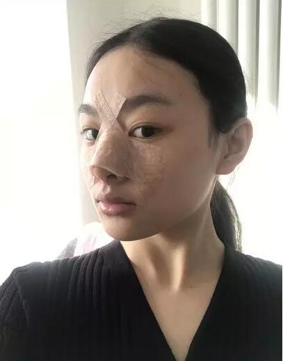 【玻尿酸隆鼻对比照片分享，术后一个月真实案例~】