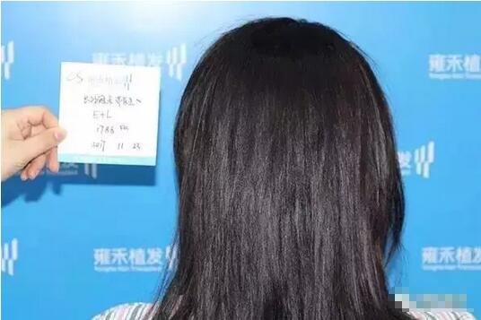 新发现植发案例