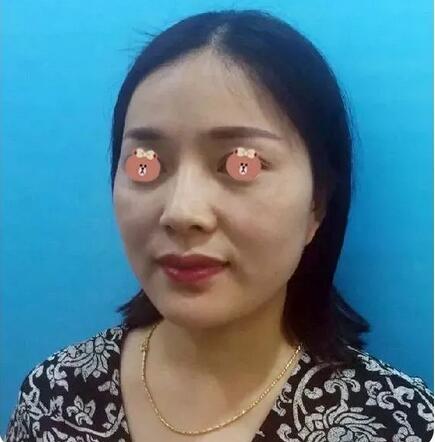 【济南伊美尔嫩肤抗老+提拉紧致经历，我佩服得五体投地！】