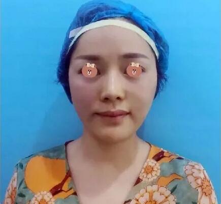 【济南伊美尔嫩肤抗老+提拉紧致经历，我佩服得五体投地！】