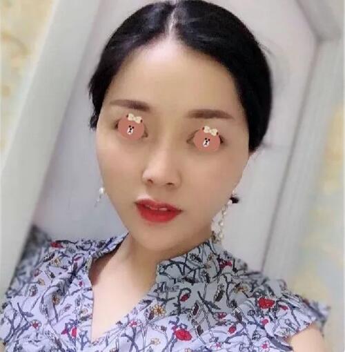 【济南伊美尔嫩肤抗老+提拉紧致经历，我佩服得五体投地！】